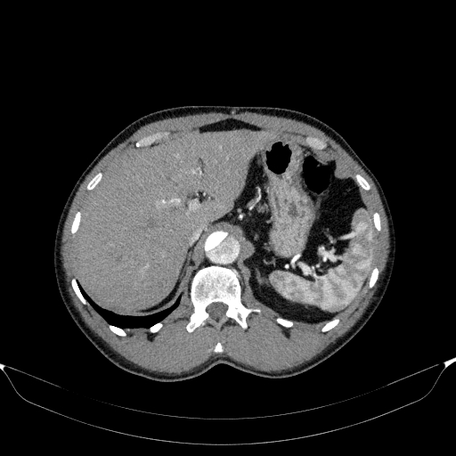 File:Aortic dissection - Stanford type A (Radiopaedia 83418-98500 A 62).jpg