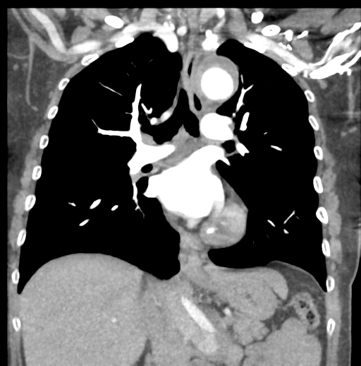 File:Aortic dissection - Stanford type B (Radiopaedia 50171-55512 B 44).png