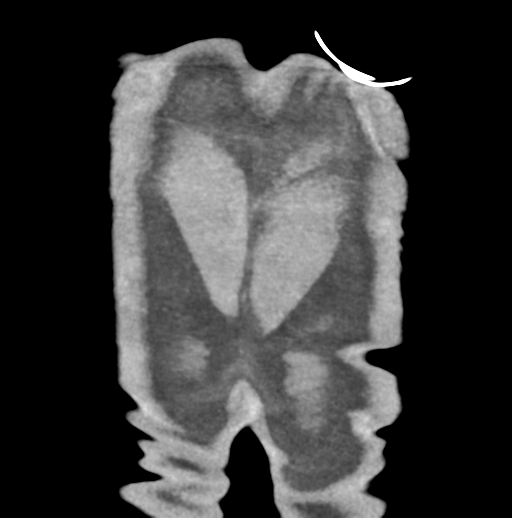 Aortic dissection - Stanford type B (Radiopaedia 50171-55512 B 85).png