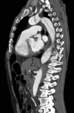 Aortic dissection - Stanford type B (Radiopaedia 73648-84437 C 67).jpg