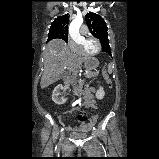 File:Aortic dissection - Stanford type B (Radiopaedia 88281-104910 B 24).jpg