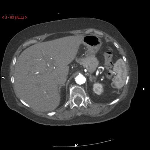 Aortic intramural hematoma (Radiopaedia 27746-28001 A 89).jpg