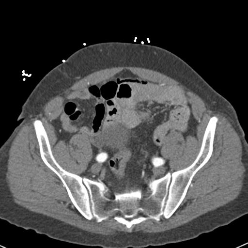Aortic intramural hematoma (Radiopaedia 31139-31838 B 142).jpg