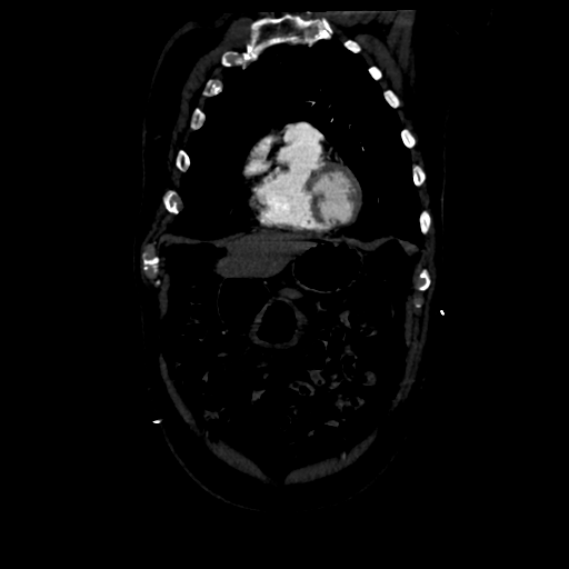 Aortic intramural hematoma (Radiopaedia 34260-35540 C 20).png