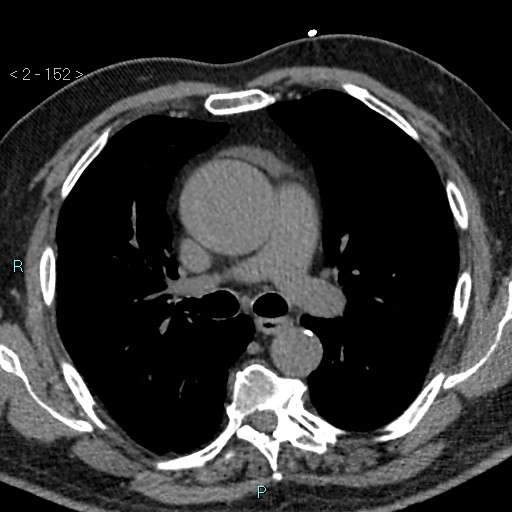 Aortic intramural hematoma (Radiopaedia 48463-53380 Axial non-contrast 68).jpg