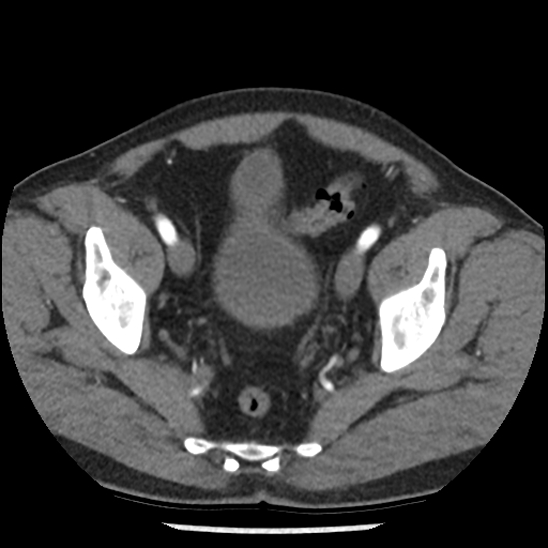 File:Aortic intramural hematoma (type B) (Radiopaedia 79323-92387 B 104).jpg