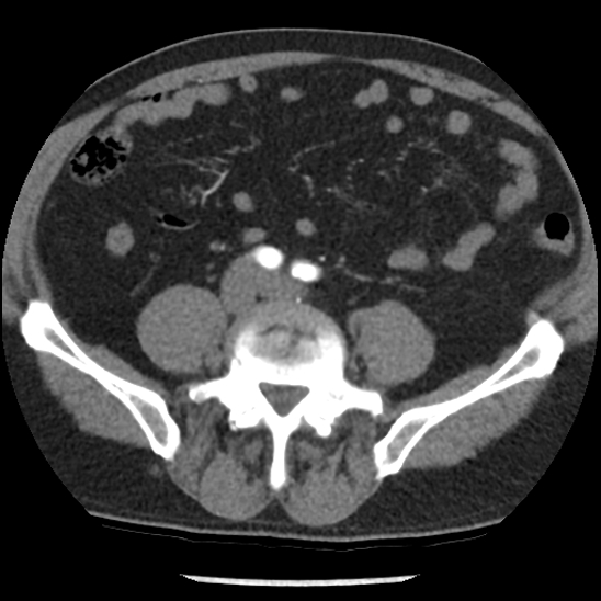 Aortic intramural hematoma (type B) (Radiopaedia 79323-92387 B 86).jpg
