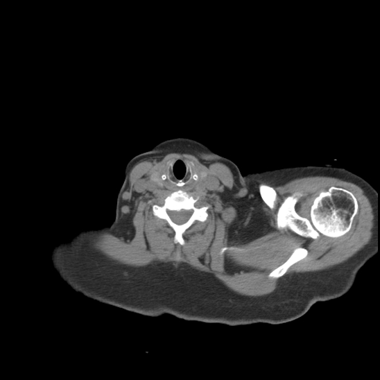 Aortic intramural hematoma with dissection and intramural blood pool (Radiopaedia 77373-89491 Axial non-contrast 2).jpg