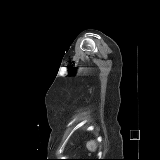 Aortic intramural hematoma with dissection and intramural blood pool (Radiopaedia 77373-89491 D 86).jpg