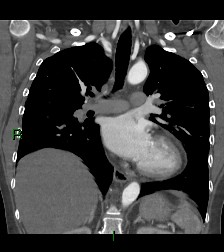 File:Aortic valve endocarditis (Radiopaedia 87209-103485 D 33).jpg