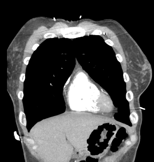 Aortic valve non-coronary cusp thrombus (Radiopaedia 55661-62189 C 18).png
