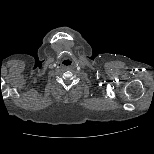 File:Aorto-coronary bypass graft aneurysms (Radiopaedia 40562-43157 A 3).png
