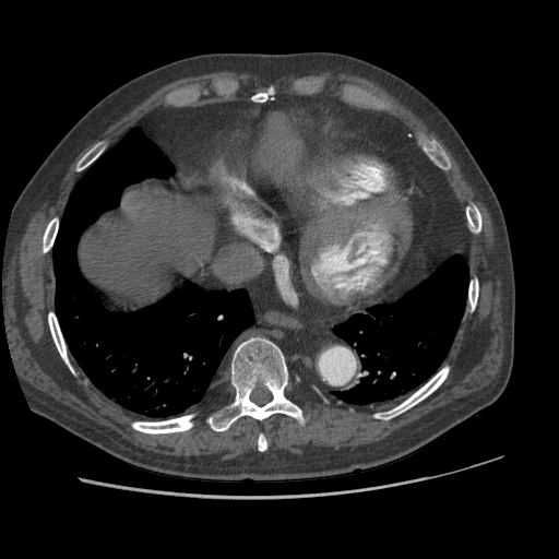 File:Aorto-coronary bypass graft aneurysms (Radiopaedia 40562-43157 A 93).png
