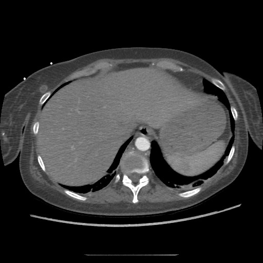Aorto-duodenal fistula (Radiopaedia 25668-25850 A 7).jpg