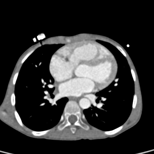 File:Aortopulmonary window, interrupted aortic arch and large PDA giving the descending aorta (Radiopaedia 35573-37074 B 52).jpg