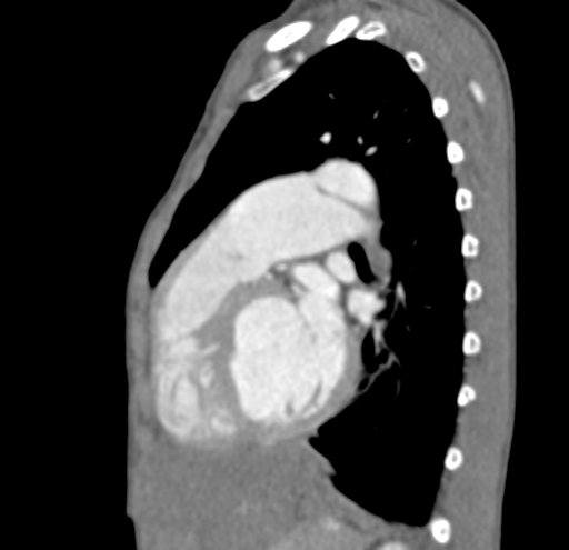 File:Aortopulmonary window, interrupted aortic arch and large PDA giving the descending aorta (Radiopaedia 35573-37074 C 30).jpg
