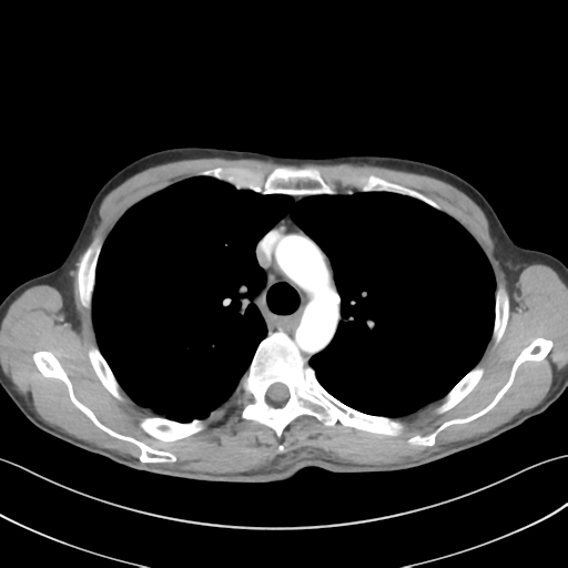 Apical pleural calcification (Radiopaedia 46141-50499 Axial C+ delayed 22).png