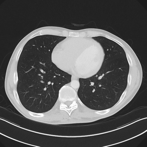 Apical pleural calcification (Radiopaedia 46141-50499 Axial lung window 47).png