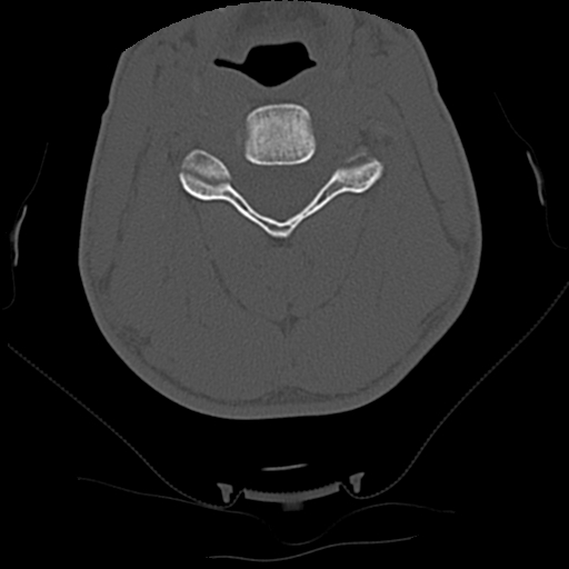 File:Apical pneumothorax on cervical spine CT (Radiopaedia 45343-49368 Axial bone window 45).jpg