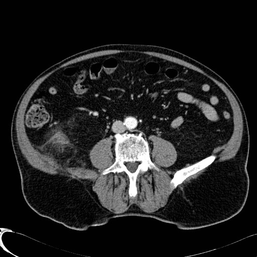 File:Appendiceal adenocarcinoma complicated by retroperitoneal abscess (Radiopaedia 58007-65039 B 81).jpg