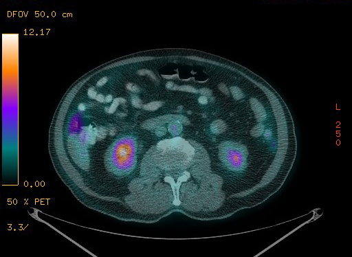File:Appendiceal adenocarcinoma complicated by retroperitoneal abscess (Radiopaedia 58007-65041 Axial PET-CT 129).jpg