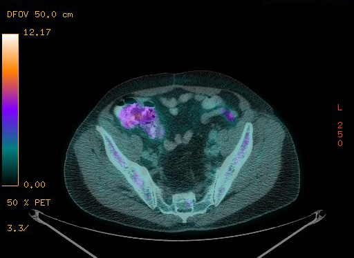 File:Appendiceal adenocarcinoma complicated by retroperitoneal abscess (Radiopaedia 58007-65041 Axial PET-CT 169).jpg