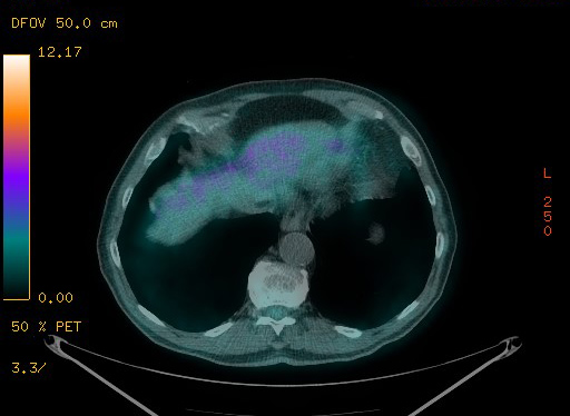 Appendiceal adenocarcinoma complicated by retroperitoneal abscess (Radiopaedia 58007-65041 Axial PET-CT 98).jpg