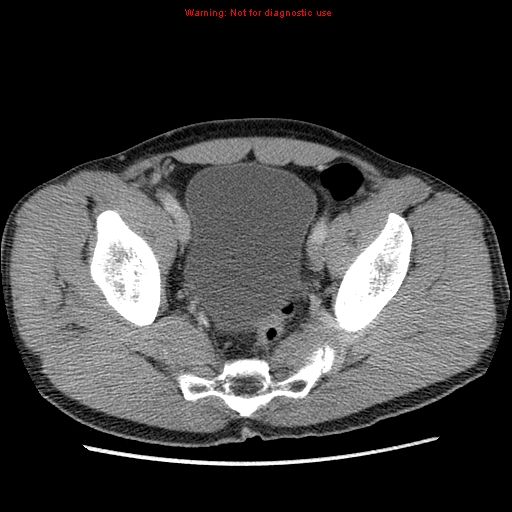 Appendicitis and renal cell carcinoma (Radiopaedia 17063-16760 A 49).jpg
