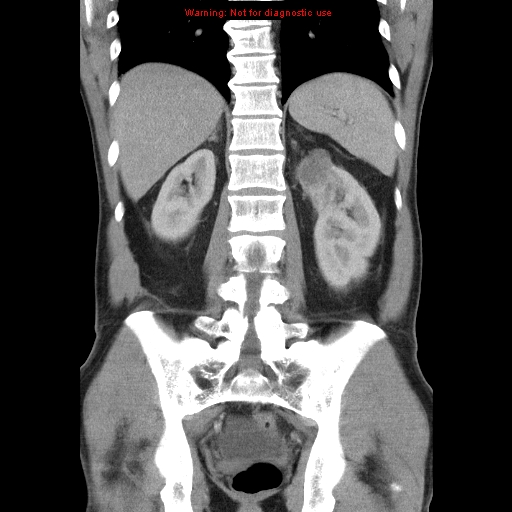 File:Appendicitis and renal cell carcinoma (Radiopaedia 17063-16760 B 22).jpg