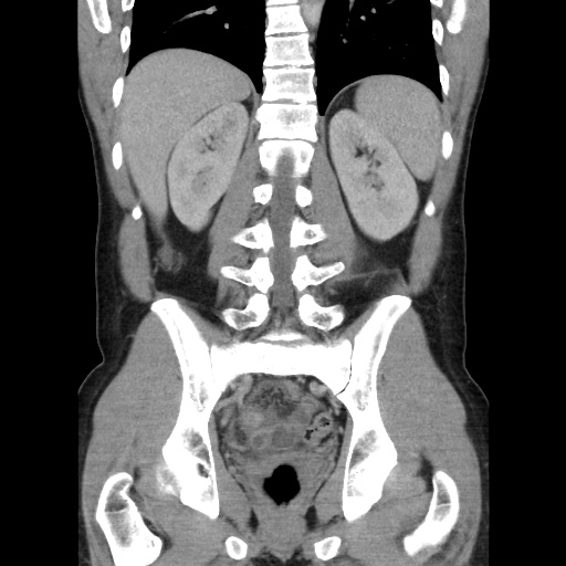 Appendicitis complicated by post-operative collection (Radiopaedia 35595-37114 B 38).jpg