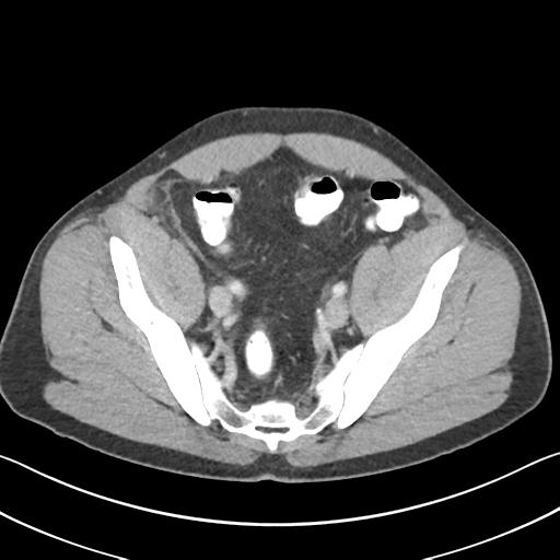 Appendicitis with cecal bar sign (Radiopaedia 31878-32830 B 65).jpg