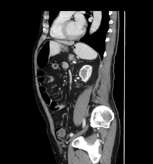 Appendicitis with localized perforation and abscess formation (Radiopaedia 49035-54130 C 42).jpg