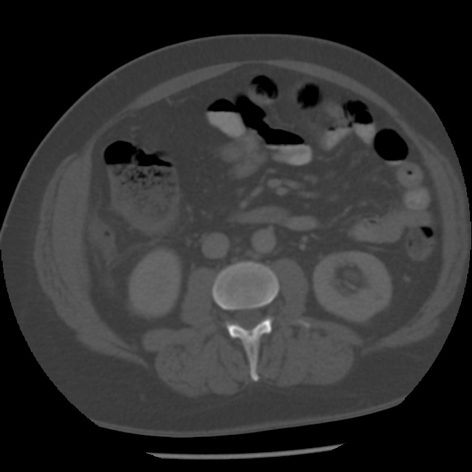 Appendicitis with perforation (Radiopaedia 35790-37342 Axial bone window 25).jpg