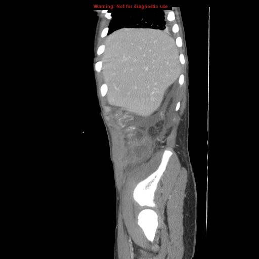 File:Appendicitis with phlegmon (Radiopaedia 9358-10046 F 4).jpg
