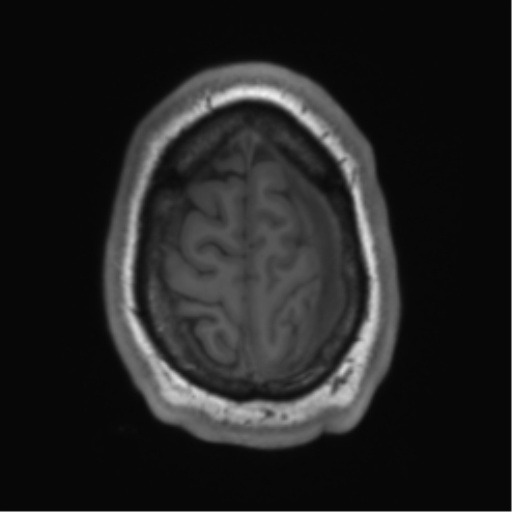 File:Arachnoid cyst with subdural hematoma (Radiopaedia 85892-101743 Axial T1 75).png