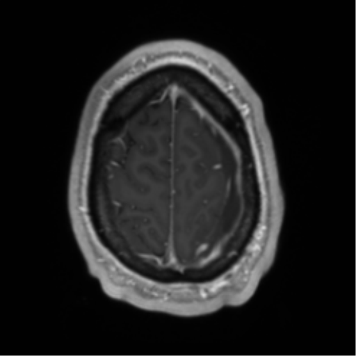 Arachnoid cyst with subdural hematoma (Radiopaedia 85892-101743 Axial T1 C+ 73).png