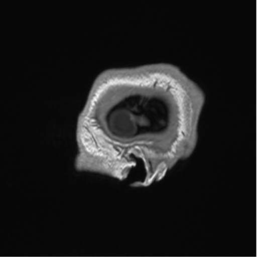 Arachnoid cyst with subdural hematoma (Radiopaedia 85892-101743 Sagittal T1 7).png