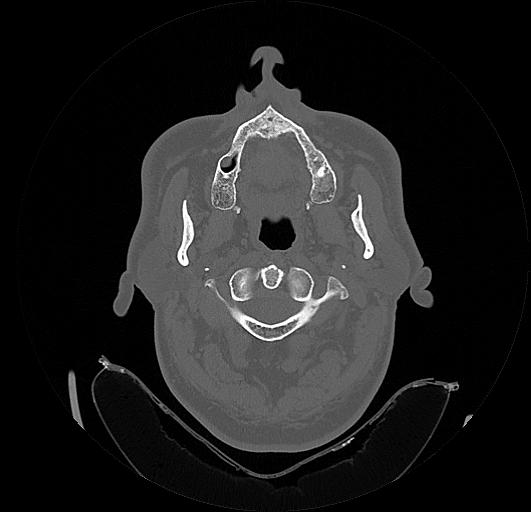 Arcuate foramen (Radiopaedia 89833-106944 Axial bone window 34).jpg