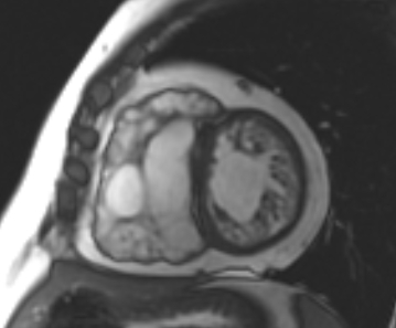 Arrhythmogenic right ventricular cardiomyopathy (Radiopaedia 69431-79307 Short axis cine 118).jpg