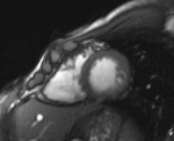 Arrhythmogenic right ventricular cardiomyopathy (Radiopaedia 69564-79464 short axis cine 83).jpg