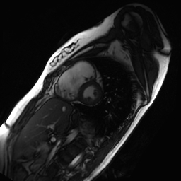 Arrhythmogenic right ventricular cardiomyopathy (Radiopaedia 87505-103850 short axis Cine SSFP 126).jpg