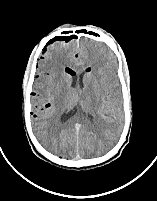 Arrow injury to the brain (Radiopaedia 72101-82607 Axial non-contrast 74).jpg