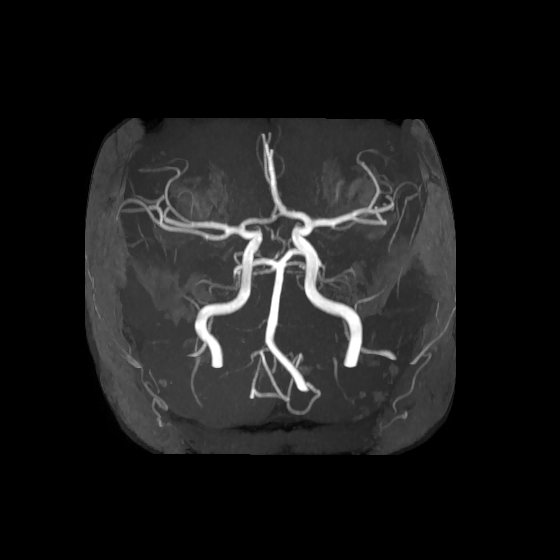 File:Artery of Percheron infarct (Radiopaedia 40966-43676 F 10).jpg