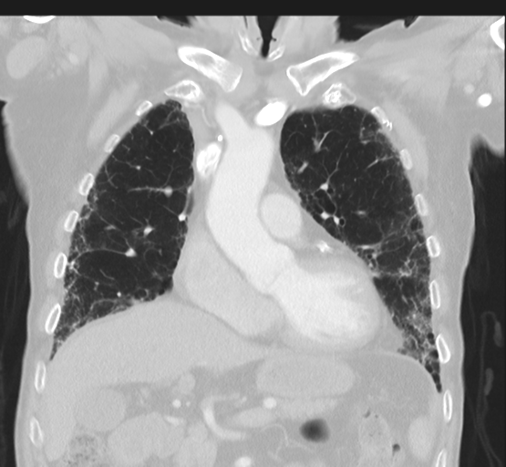 File:Asbestosis (Radiopaedia 56192-62864 Coronal lung window 19).png