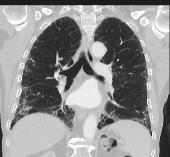 Asbestosis (Radiopaedia 56192-62864 Coronal lung window 31).png