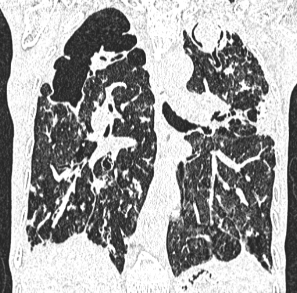 Aspergilloma- with Monod sign (Radiopaedia 44737-48532 Coronal lung window 273).jpg