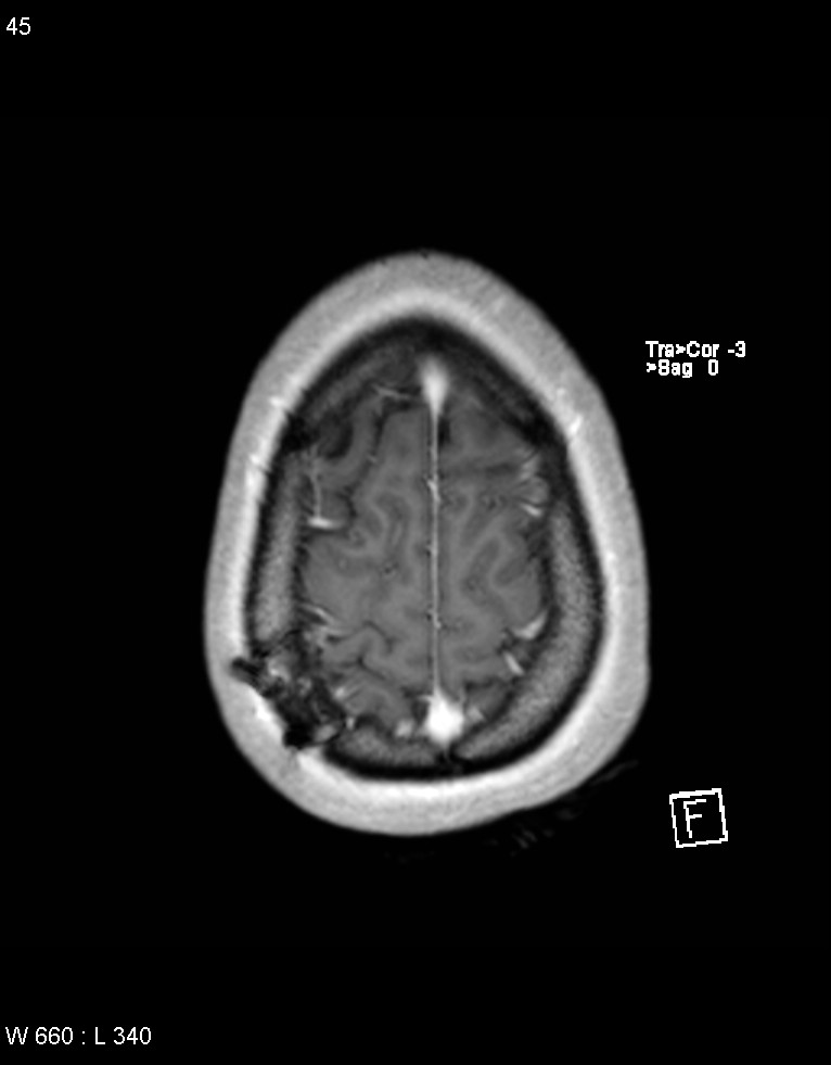 Astroblastoma (Radiopaedia 39792-42218 Axial T1 C+ 44).jpg