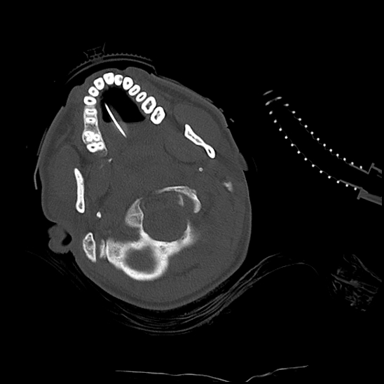 Atlanto-occipital dissociation (Traynelis type 1), C2 teardrop fracture, C6-7 facet joint dislocation (Radiopaedia 87655-104061 Axial bone window 16).jpg