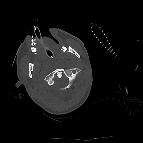 Atlanto-occipital dissociation (Traynelis type 1), C2 teardrop fracture, C6-7 facet joint dislocation (Radiopaedia 87655-104061 Axial bone window 21).jpg
