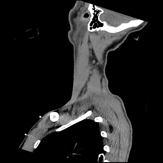 Atlanto-occipital dissociation (Traynelis type 1), C2 teardrop fracture, C6-7 facet joint dislocation (Radiopaedia 87655-104061 D 72).jpg